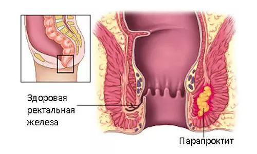 Как вылечить парапроктит в домашних условиях?