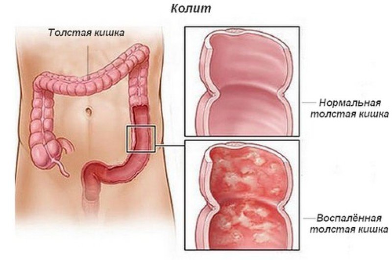 Колит кишечника у ребенка симптомы лечение питание