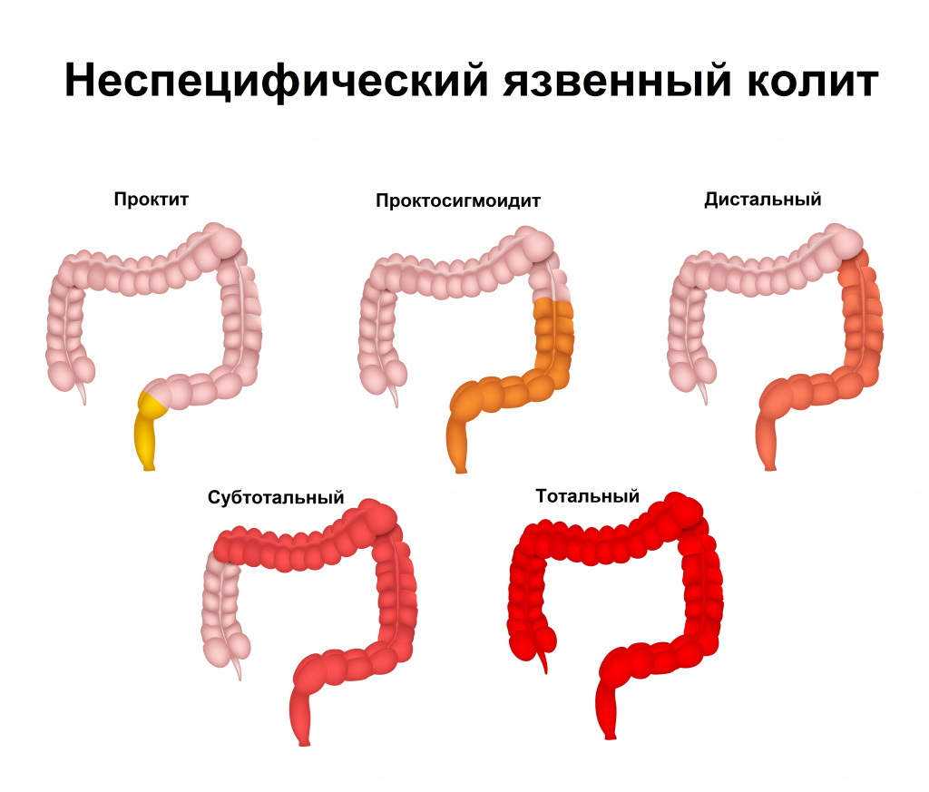 Неспецифический язвенный колит