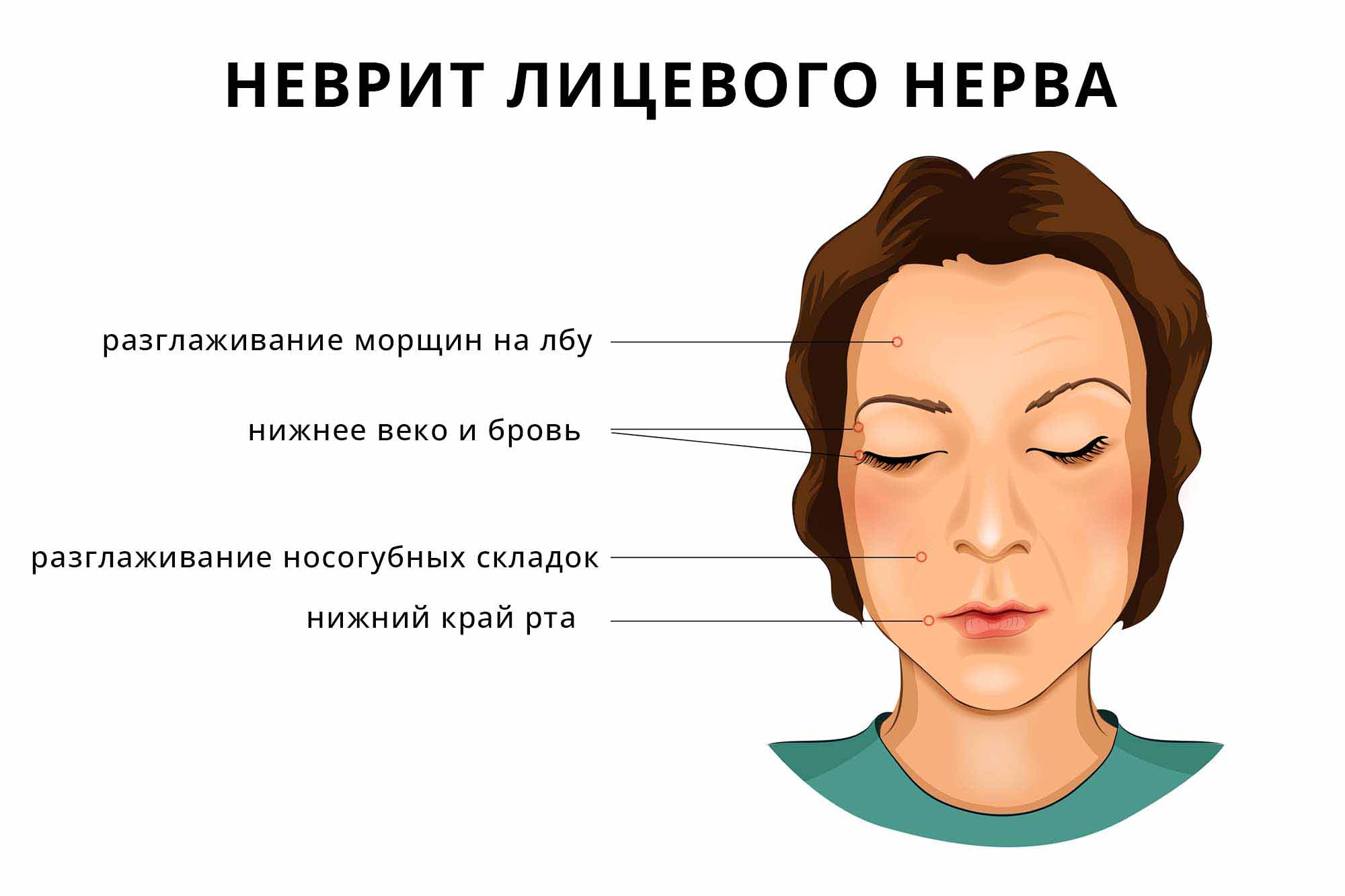 Неврит лицевого нерва: причины, симптомы, лечение