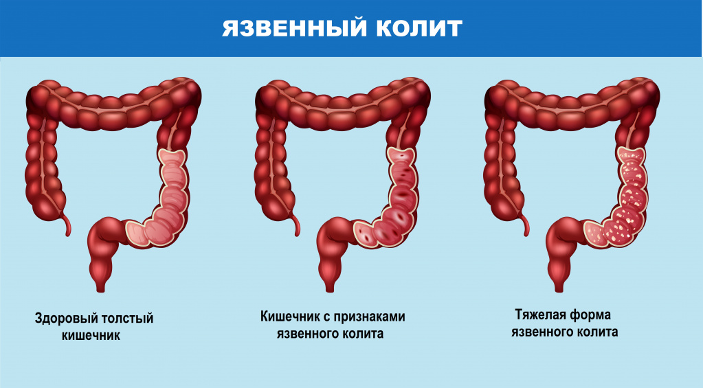 Острый колит