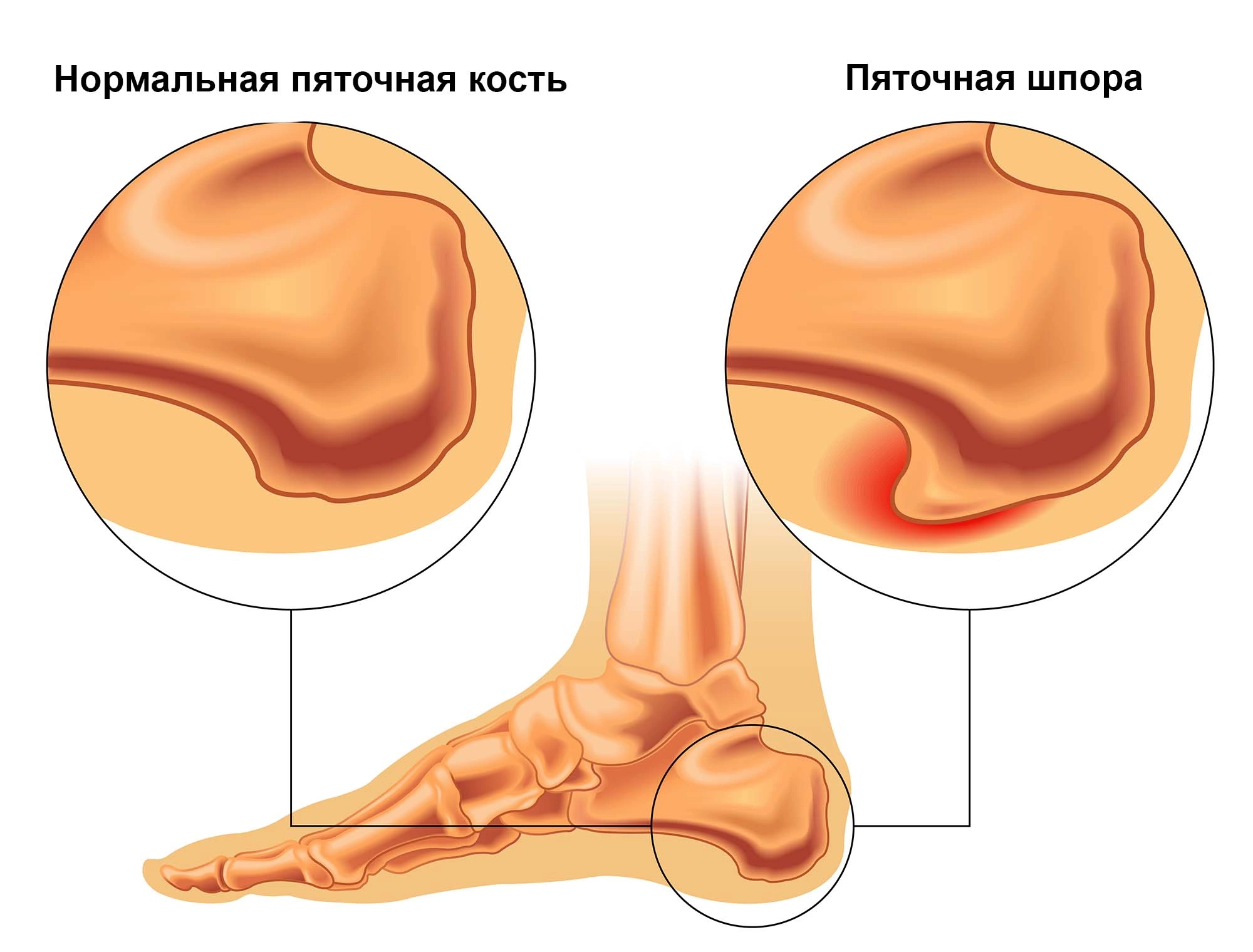 Пяточная шпора (Плантарный фасциит, Подошвенный фасциит)
