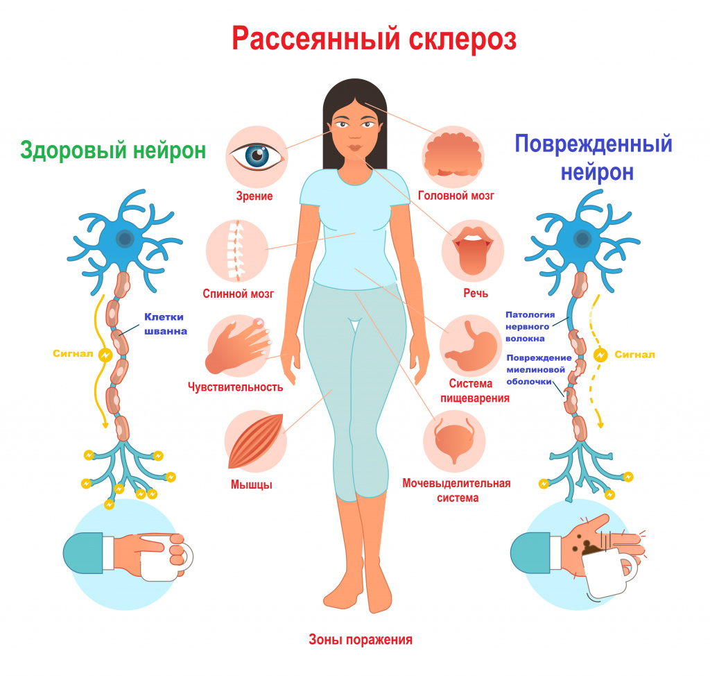 Рассеянный склероз: понятие, развитие и причины, симптомы и течение, принципы лечения, прогноз