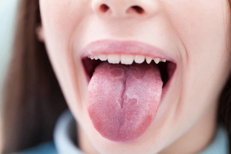 Как вылечить кандидоз полости рта: комплекс мер и диета