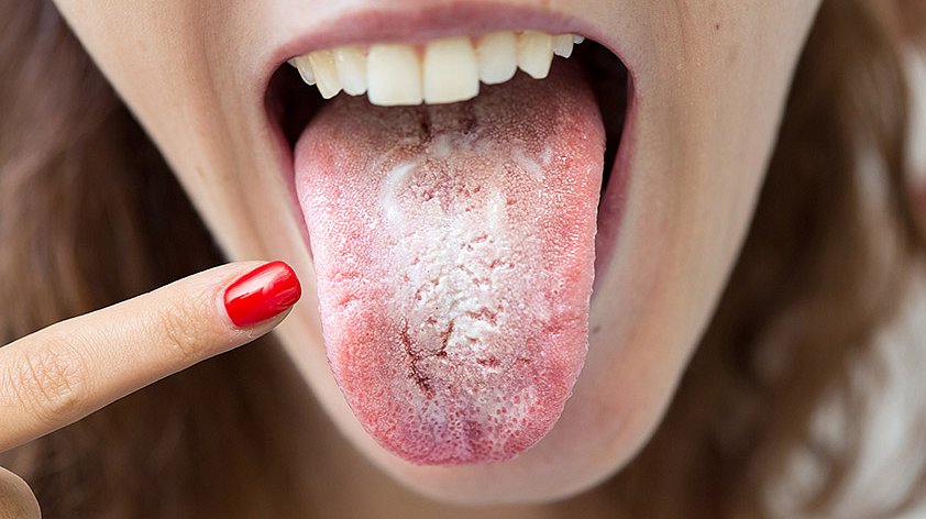 Кандидоз полости рта. Причины, симптомы и признаки, лечение кандидоза.
