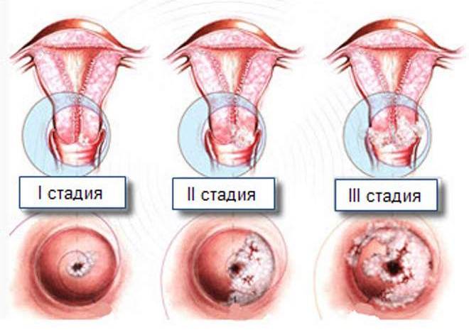 Лечение 2 стадии рака шейки матки. Сколько живут после операции?