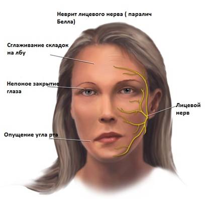 Неврит лицевого нерва: причины, симптомы, лечение